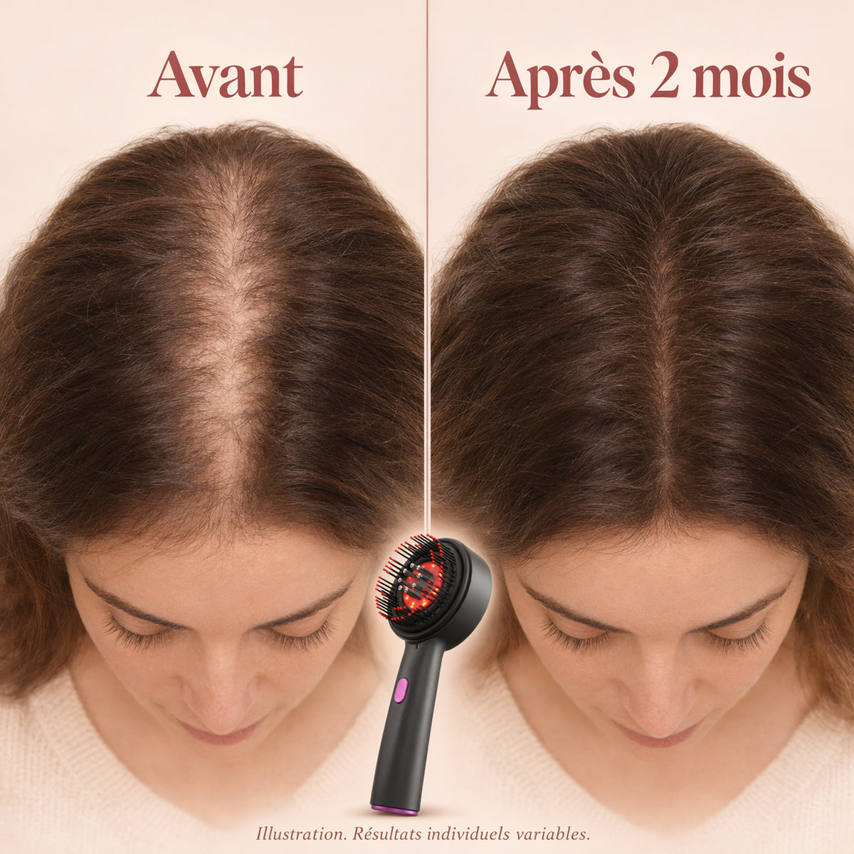 Kéra avant / après 2 mois – illustration
